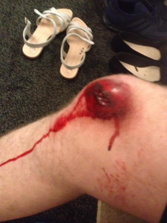 knee after off 2.jpg