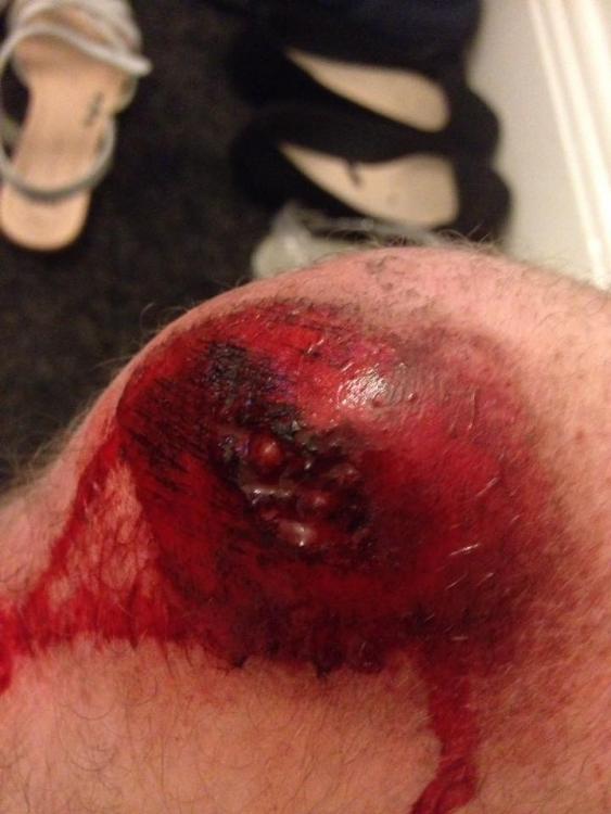 knee after off 4.jpg